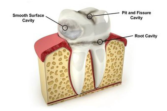 Smooth surface cavity