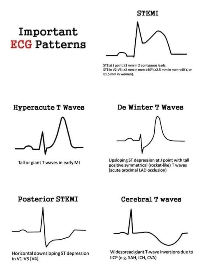 Important ECG Patterns