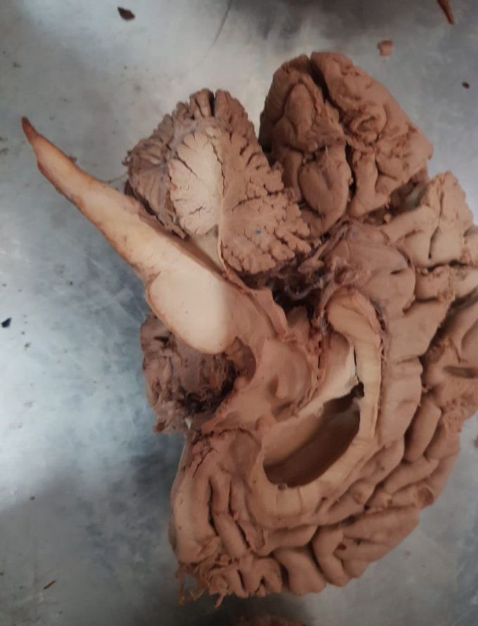 💥Beautiful brain.😊.. I love neuroanatomy a lot...💟😊