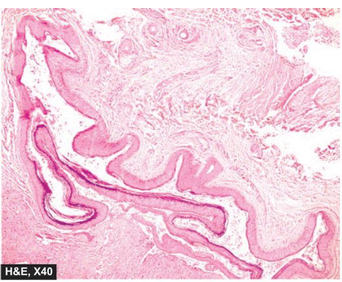 Dermoid cyst.