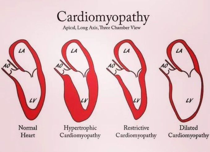 Cardiomyopathy