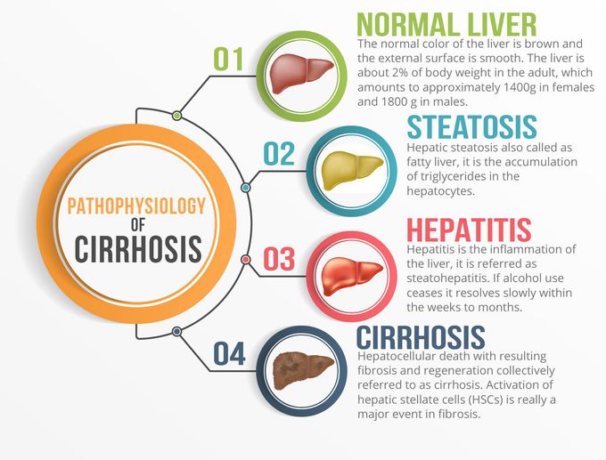 Stages of Liver Cirrhosis