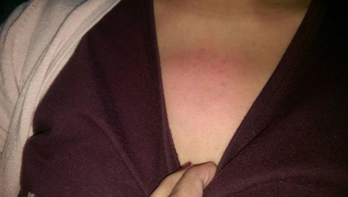 Chest pain with swelling  all blood tests and x-ray is normal