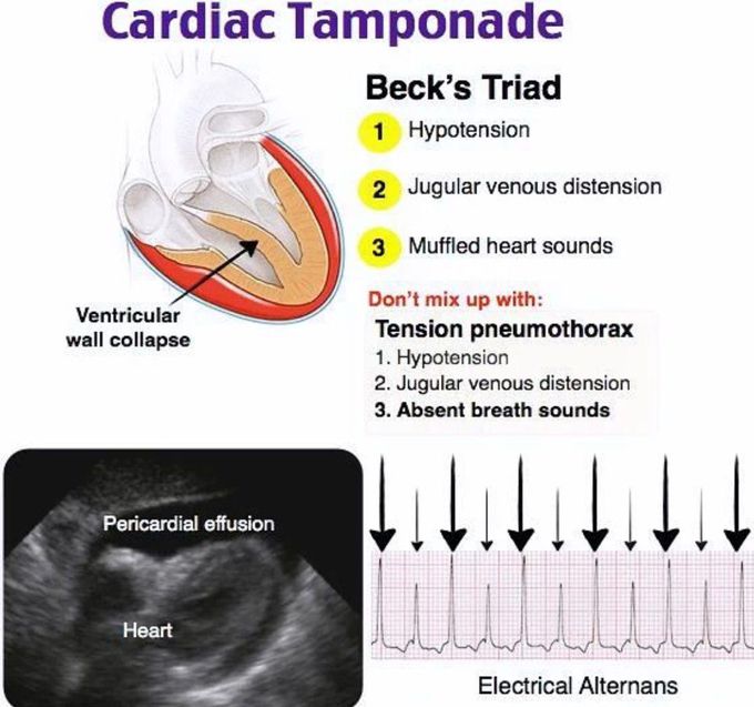 Cardiac Tamponade