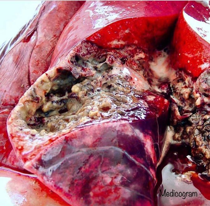 Tuberculosis
