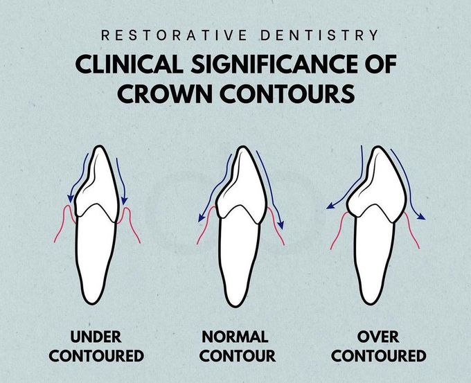 Crown Contours- Clinical Significance