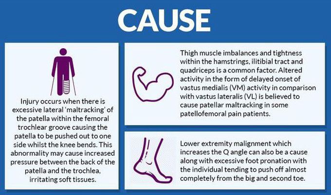 Causes of Patellar malalignment