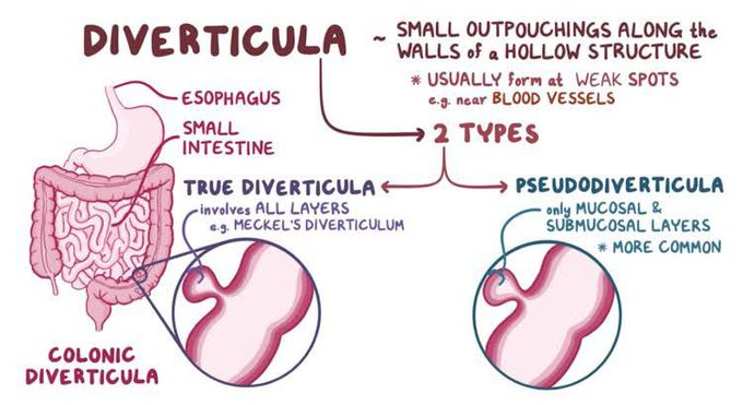 True and False Diverticula