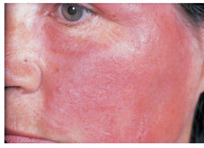 Allergic rash
