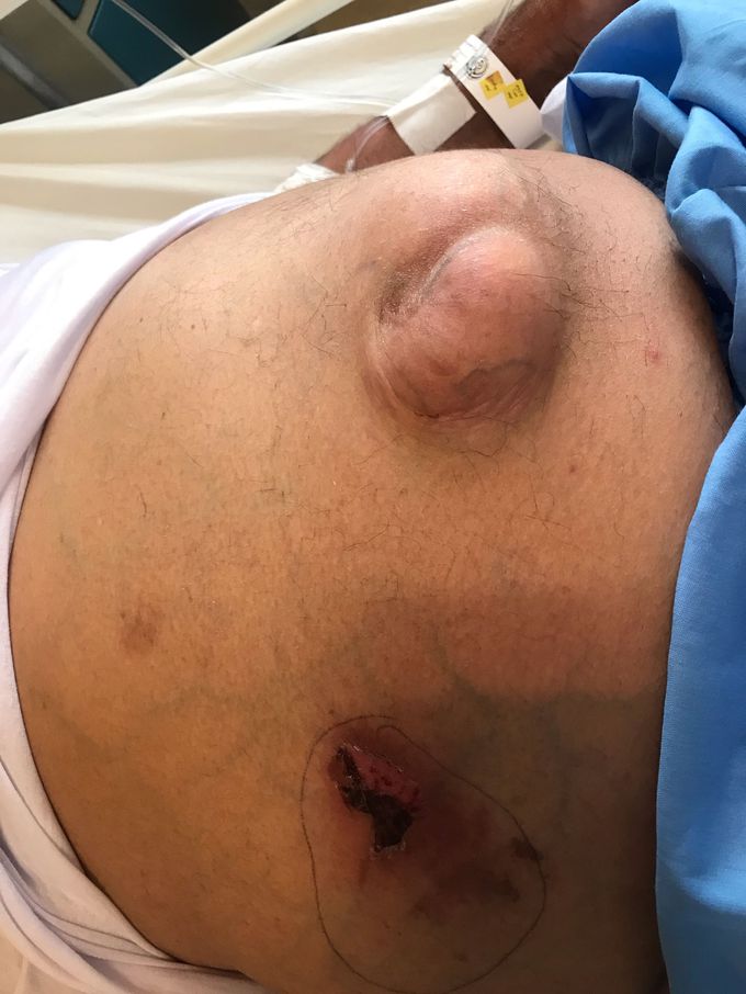Umbilical hernia