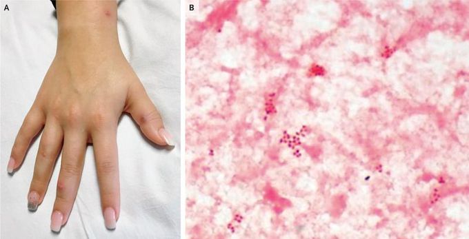 Disseminated Gonococcal Infection