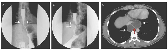 Esophageal Duplication Cyst