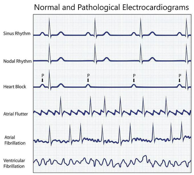 Electrocardiogram