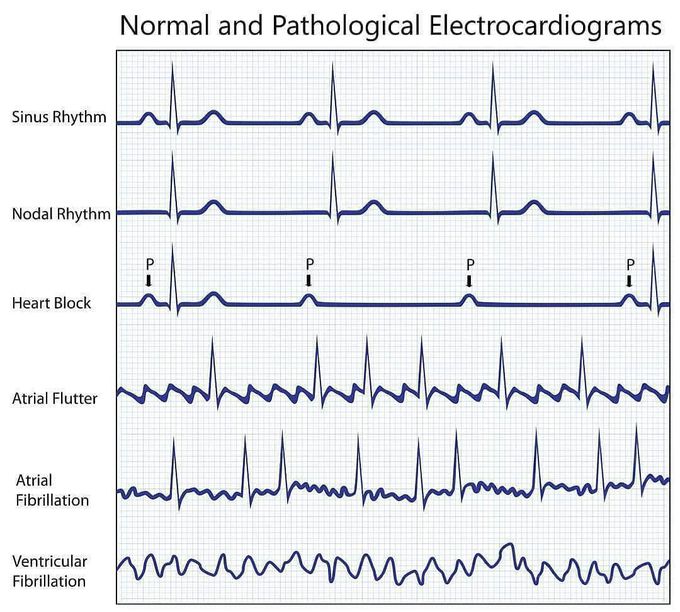 Electrocardiogram - MEDizzy