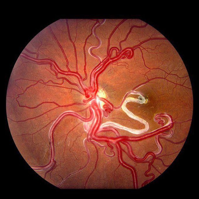 Wuyburn Mason's Syndrom (Eye)