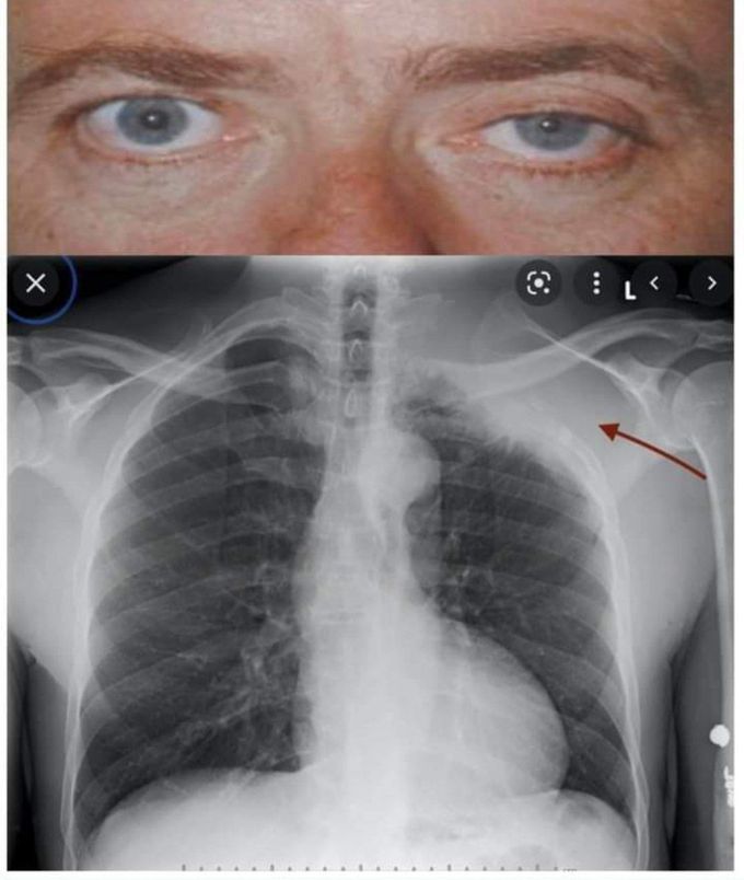 Pancoast tumor cause horner,s syndrome