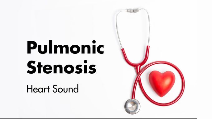 Pulmonary Stenosis | Heart Sounds