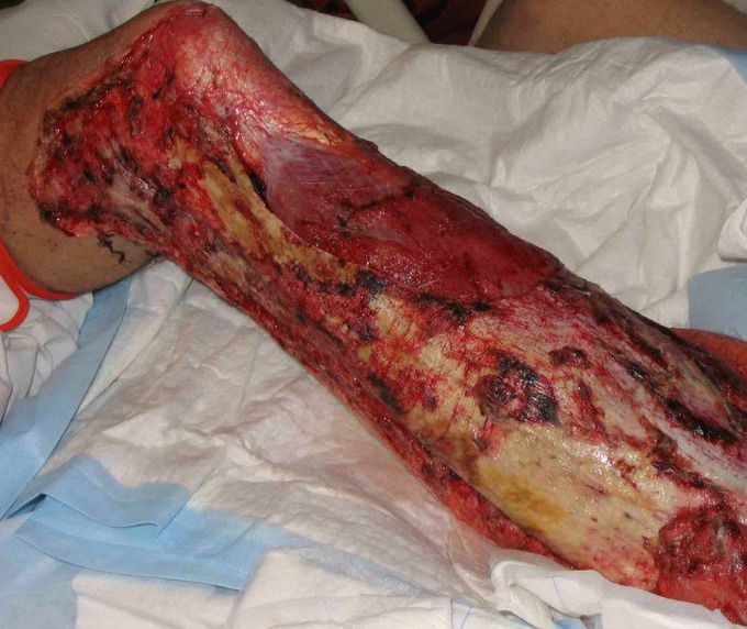 Necrotizing Fasciitis