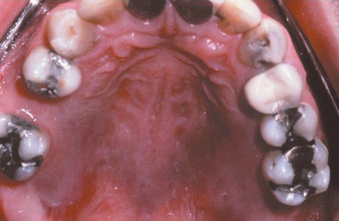 HIV-associated Kaposi Sarcoma (KS).