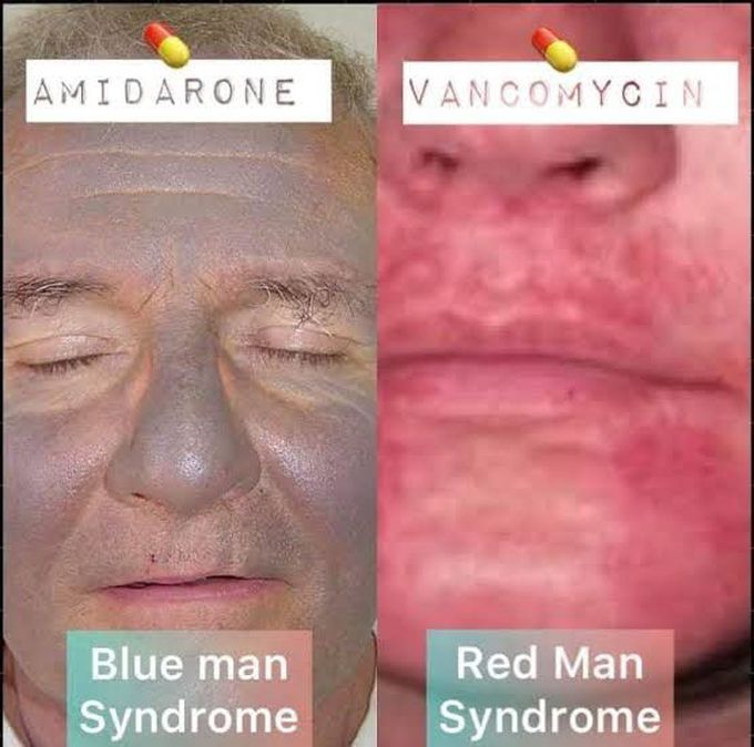 Red man syndrome and blue man syndrome
