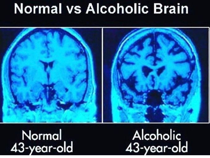 Normal Vs Alcoholic Brain