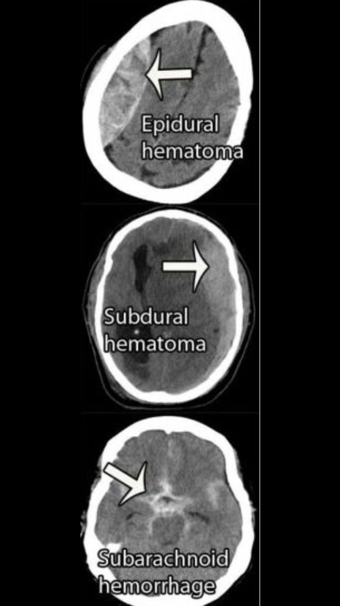 Types of hematomas shown on CT