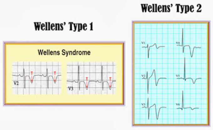 This is the difference between Wellen type 1 and 2