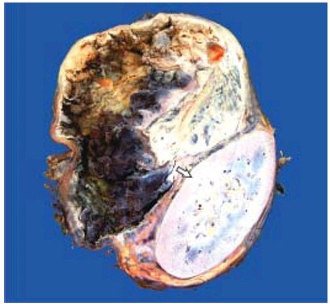 Pheochromocytoma of the adrenal medulla