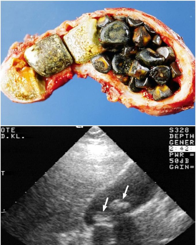 Cholelithiasis