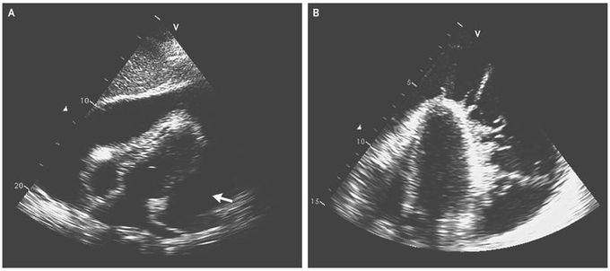 Tuberculous Pericarditis