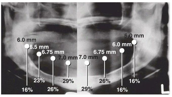 Radiographic examination for implants