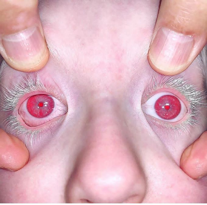 Ocular albinism