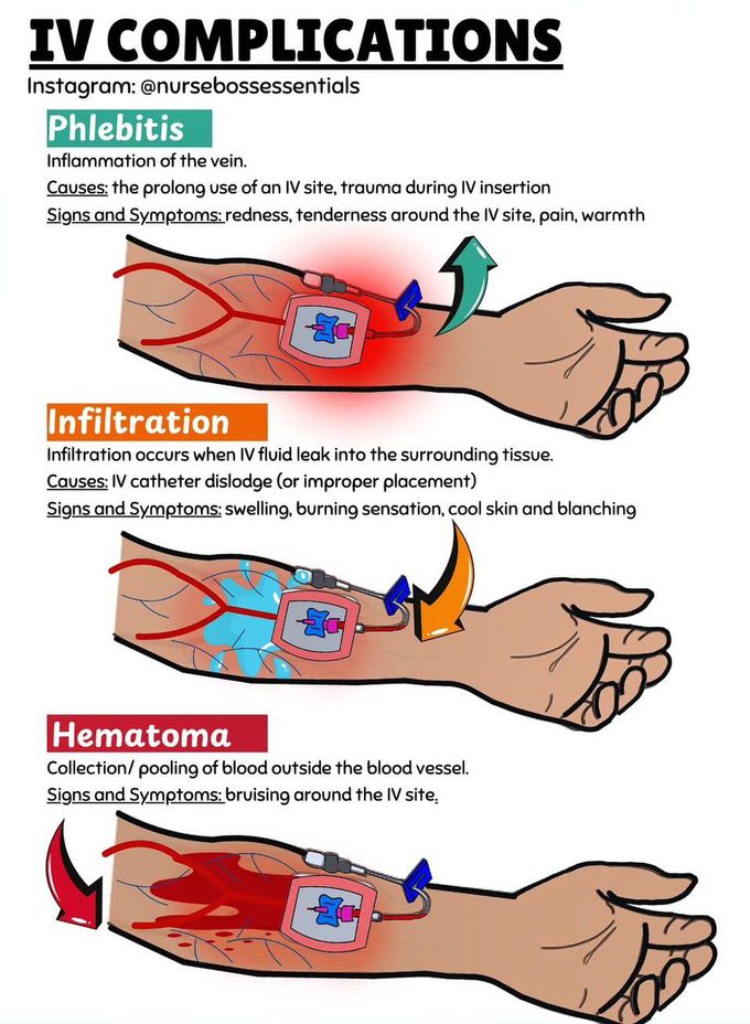 IV Complications