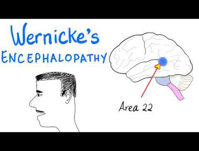 Wernicke's Encephalopathy | Vitamin B1 Deficiency | Biochemistry