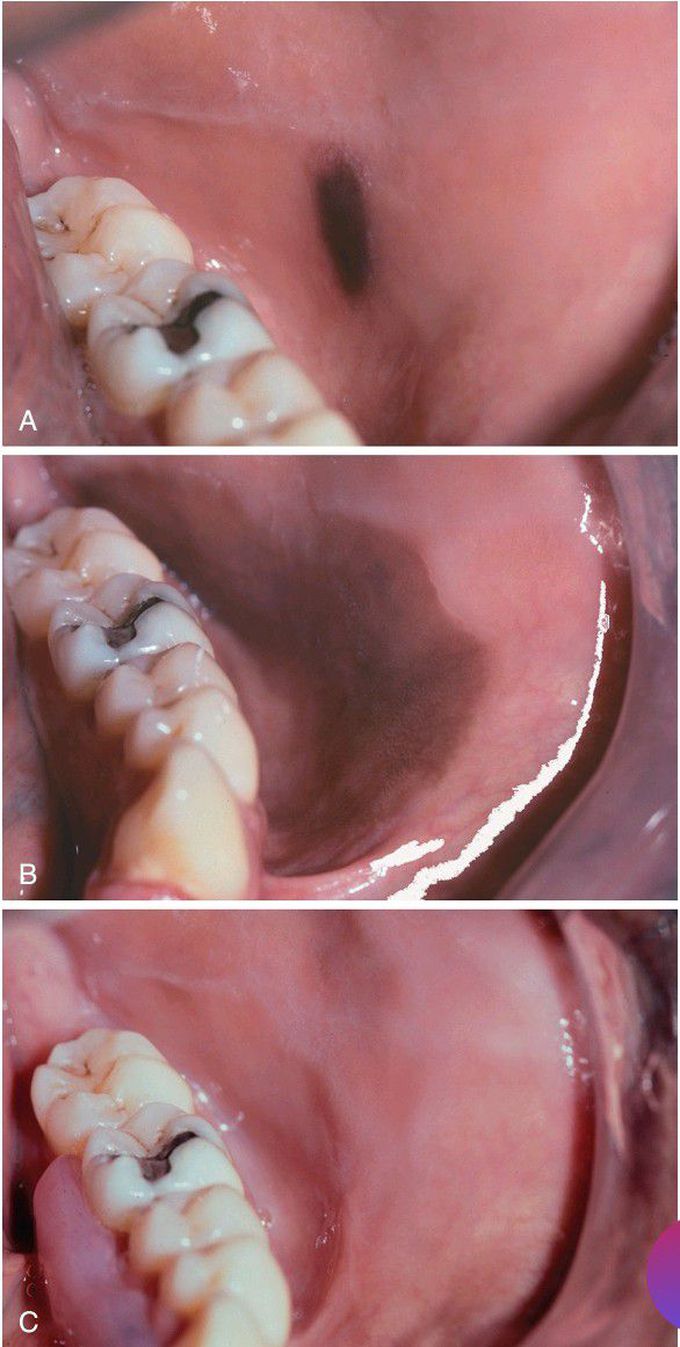 Oral Melanoacanthoma