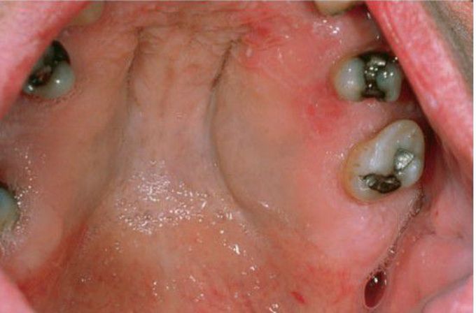 Neurofibroma of palate