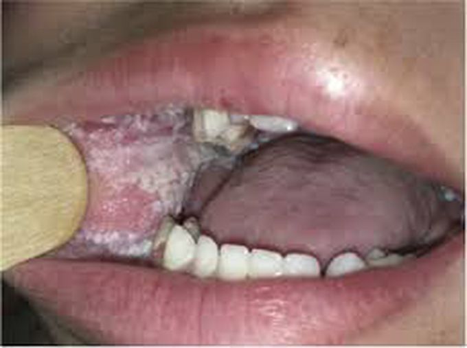 white sponge nevus