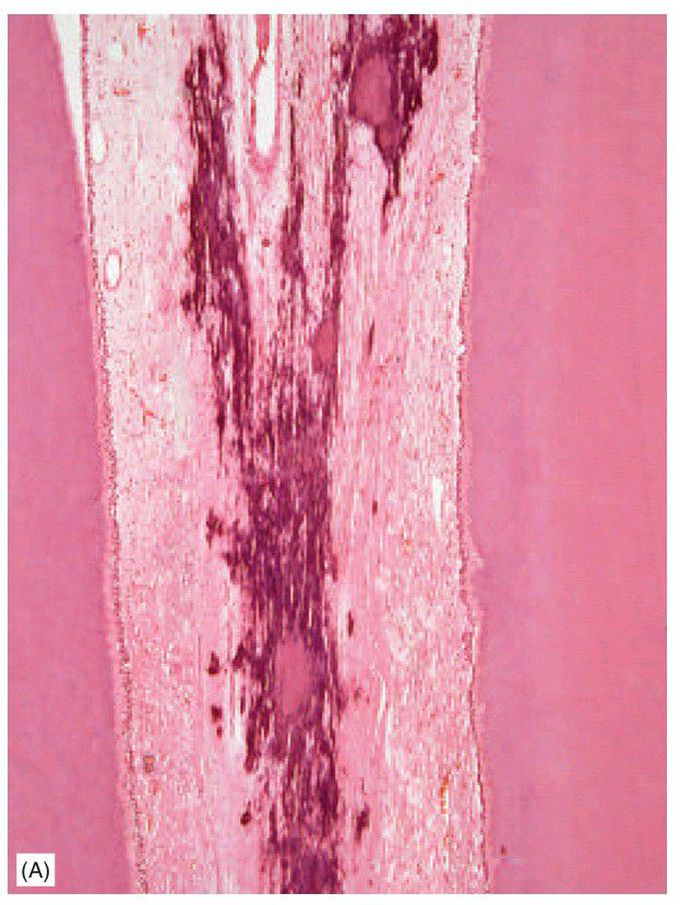 Pulp stones