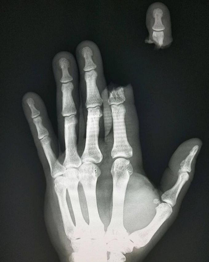 Hand x-ray showing severed finger caused by a chainsaw accident