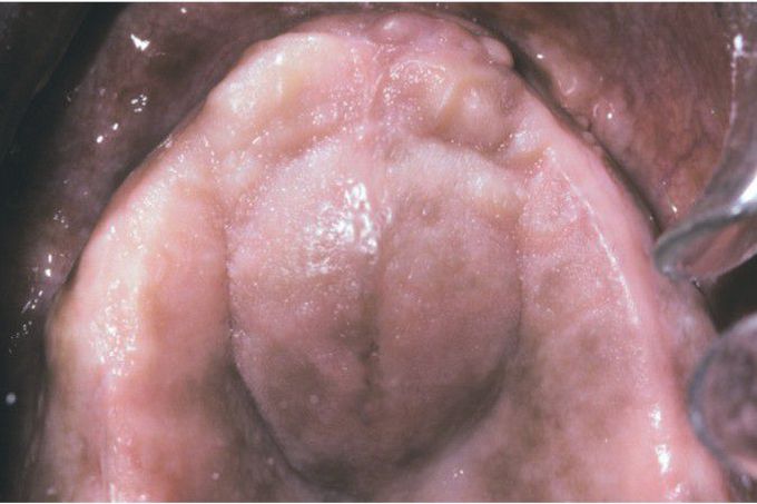 Nasopalatine duct cyst