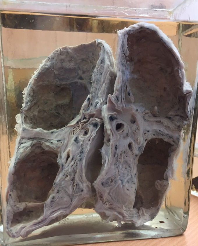 What's the pathology ?