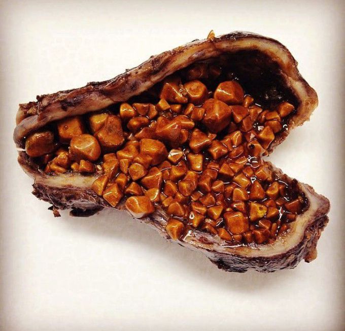 Cholesterol Gallstones