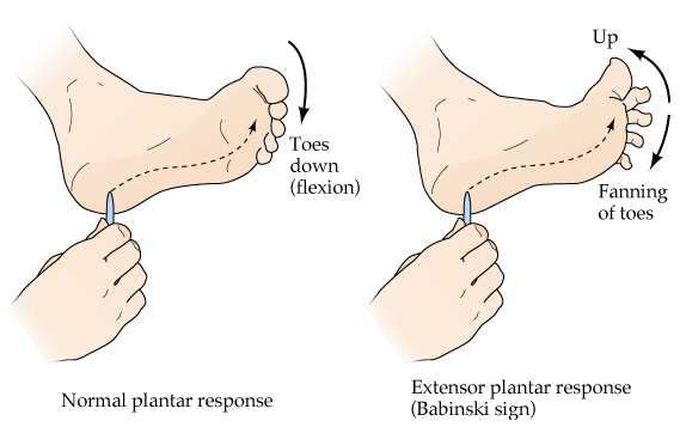 What to Know About the Babinski Reflex