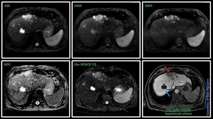 MRI Liver Imaging w/Primovist @ Siemens 1.5T AERA MRI with - MEDizzy
