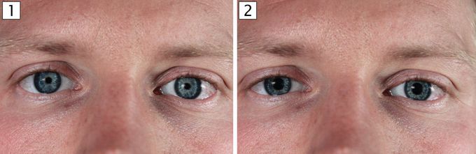 Causes of Pinpoint Pupils