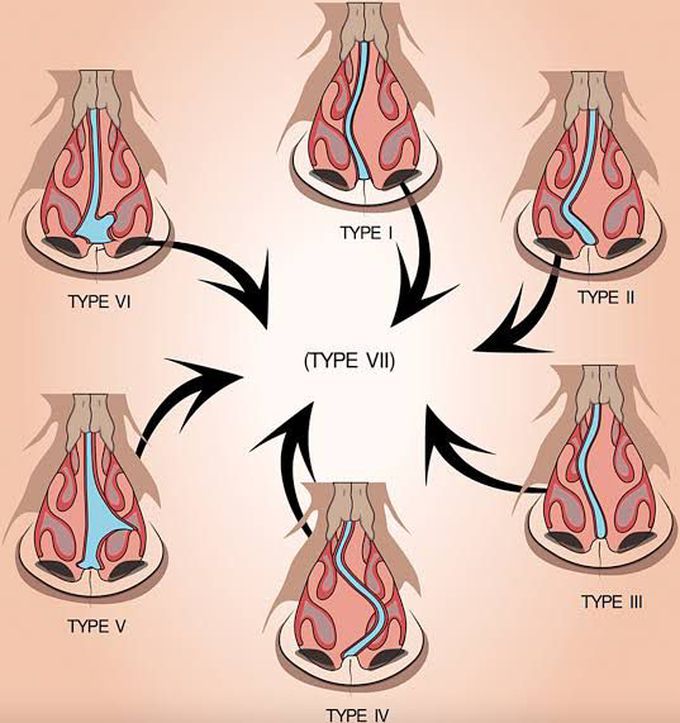 These are different types of deviations in nose