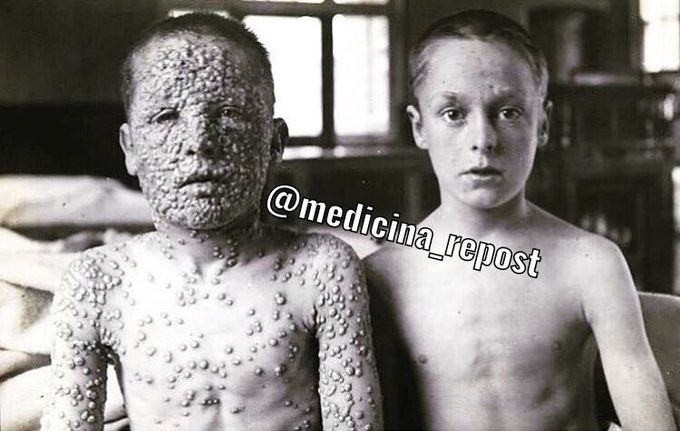 Smallpox