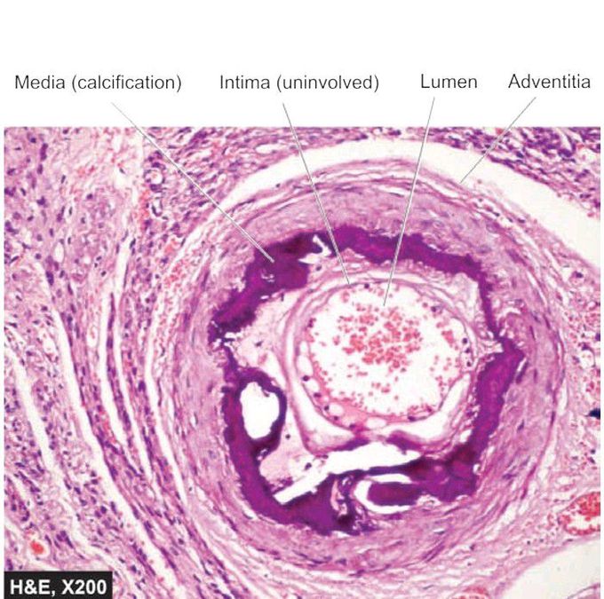 Dystrophic calcification