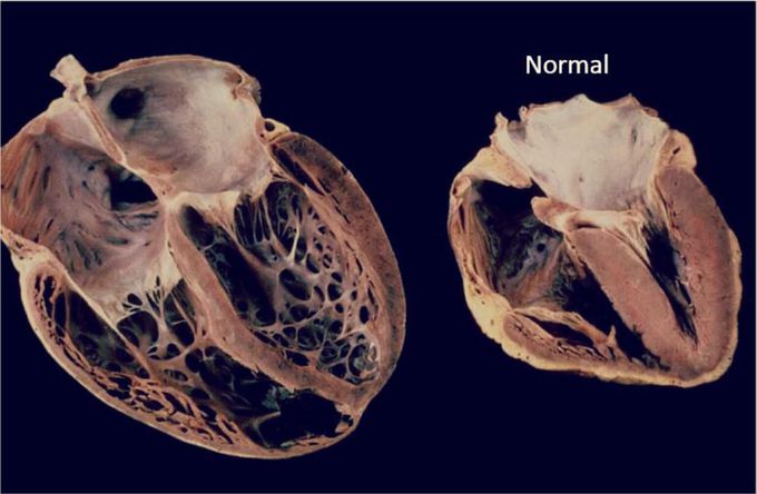 Normal heart vs. Cardiomegaly