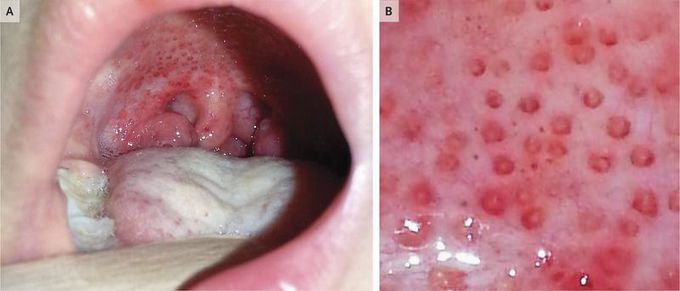 Doughnut” Lesions
